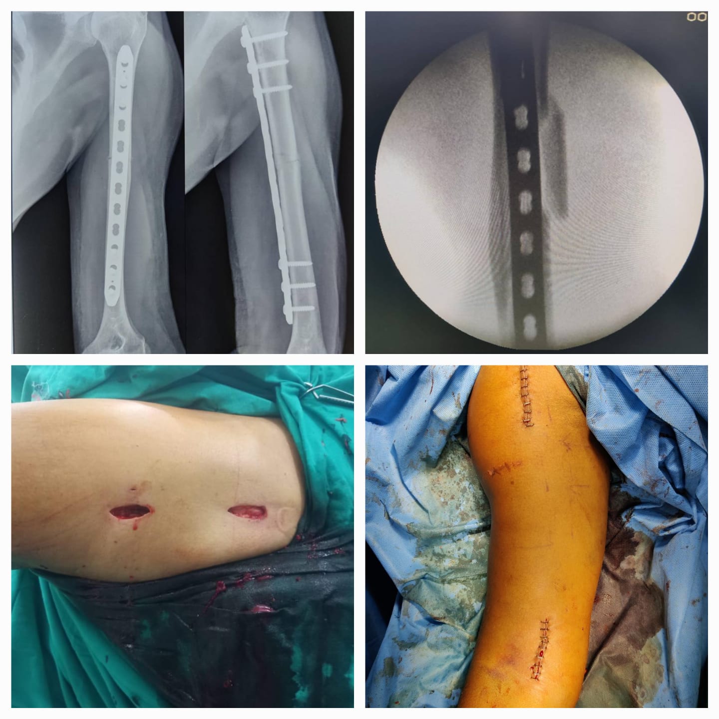 MINIMAL INVASIVE HAND SURGERY